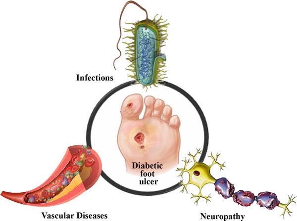 diabetik ayaq 2